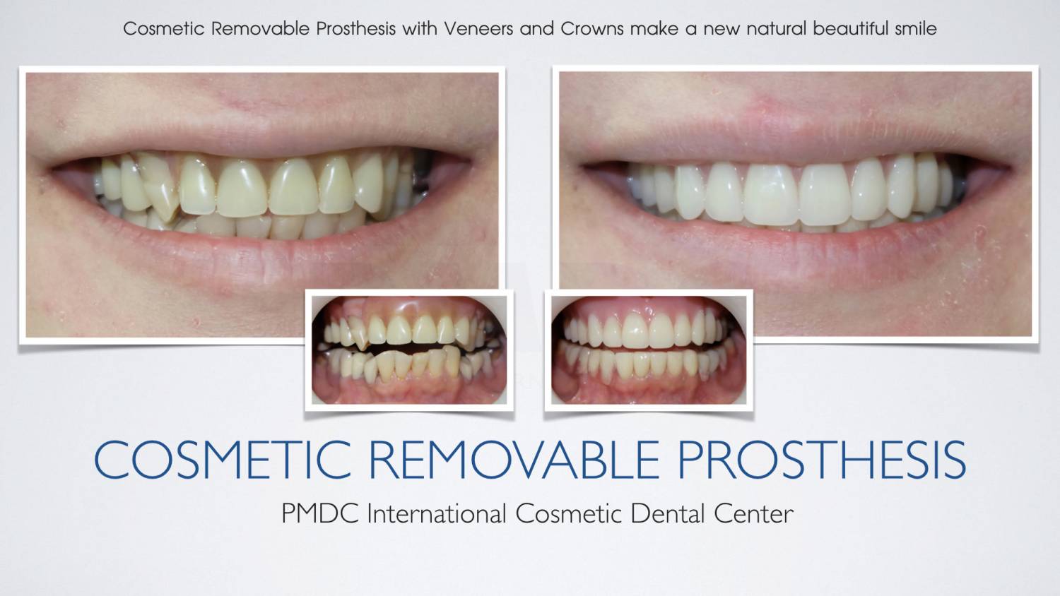 Removable Prosthesis PMDC Dental